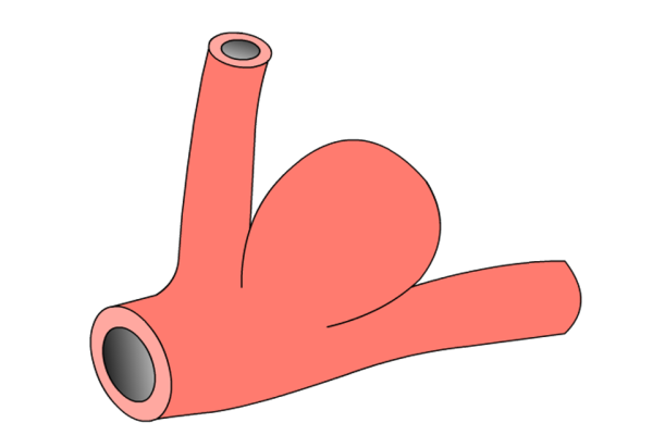Berry Aneurysm
