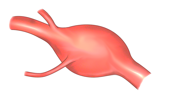 Fusiform Aneurysm